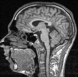 FMRI-scan_sectie_85